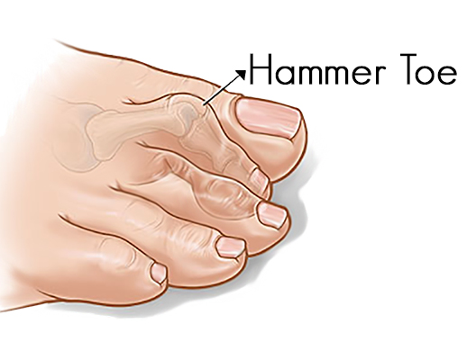 hammer toe treatment in dubai - Contact Dr. KP Meda