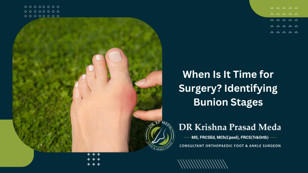 Bunion Surgery