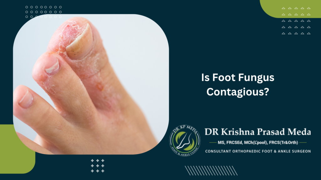Is Foot Fungus Contagious?