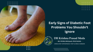 Early Signs of Diabetic Foot Problems You Shouldn’t Ignore