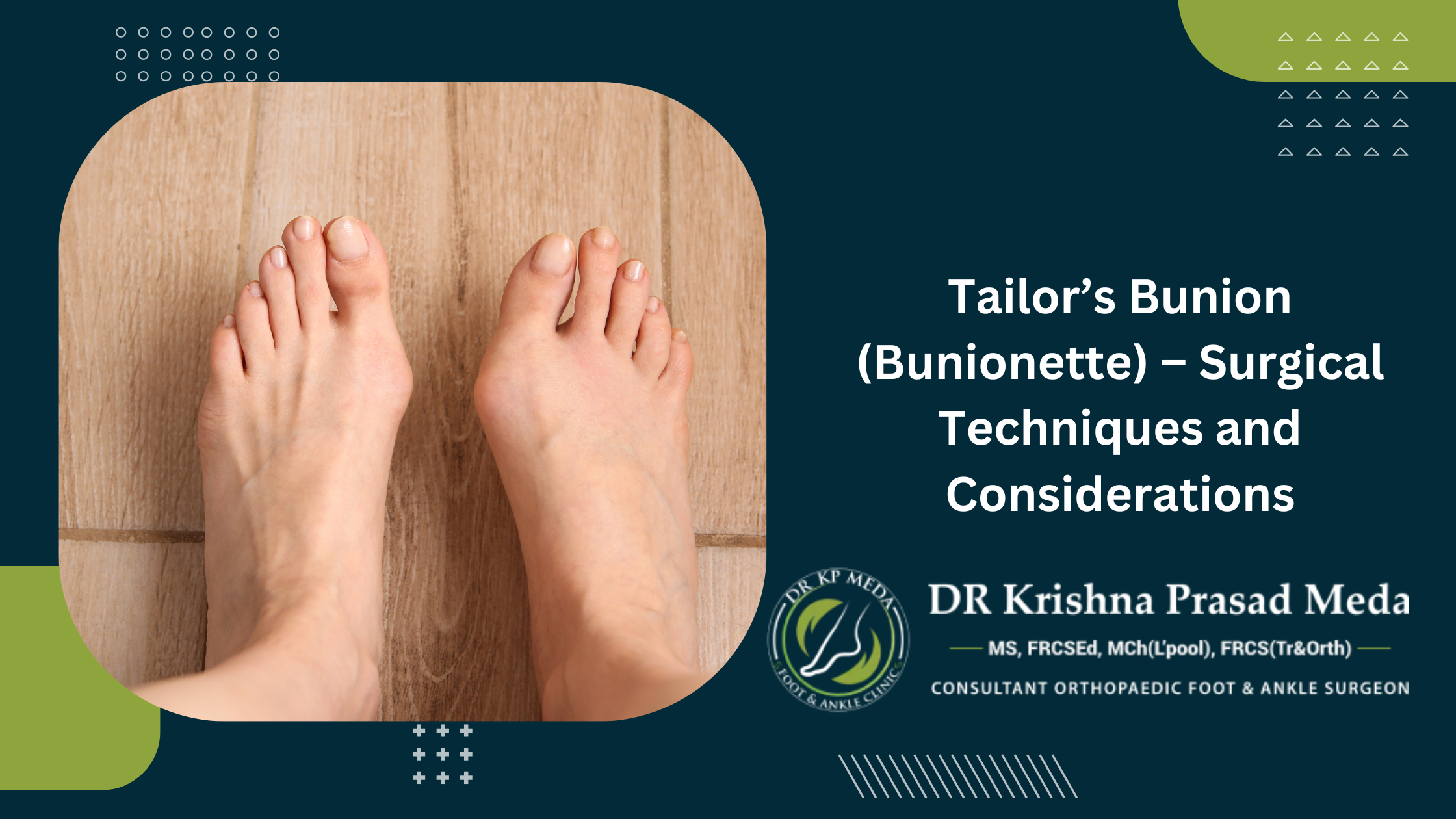 Tailor’s Bunion (Bunionette) – Surgical Techniques and Considerations