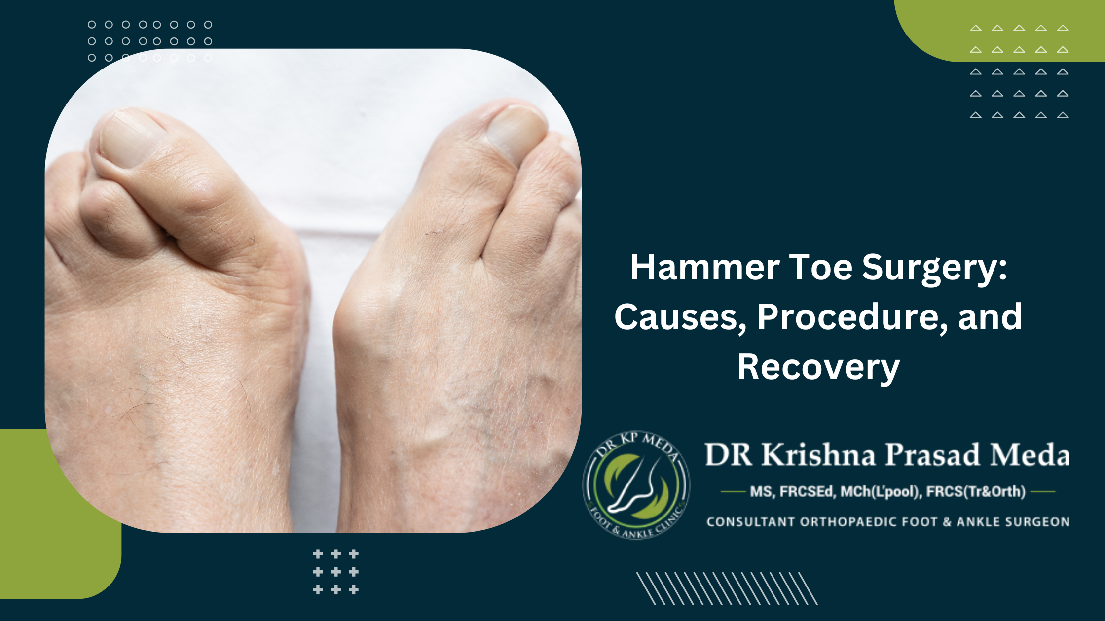 Hammer Toe Surgery: Causes, Procedure, and Recovery