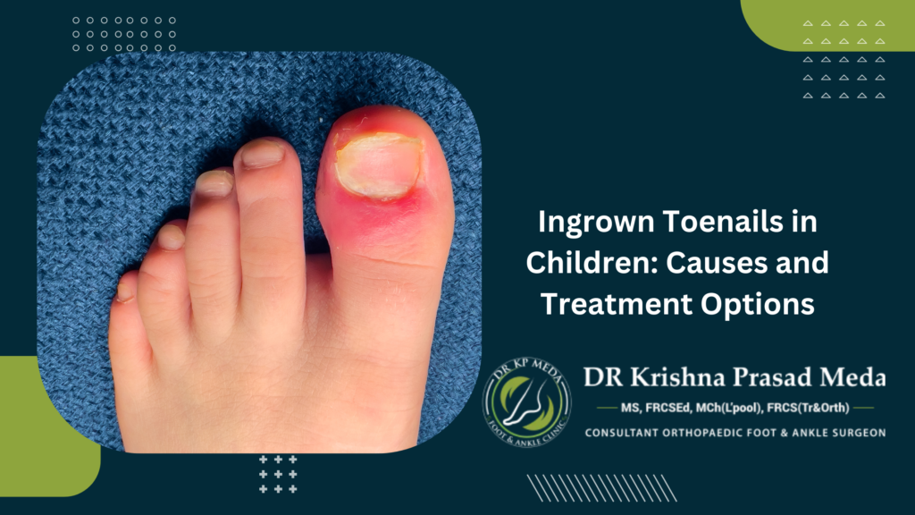 Ingrown Toenails in Children Causes and Treatment Options