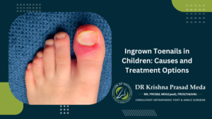 Ingrown Toenails in Children Causes and Treatment Options